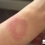 luka bakar pengguna Apple Watch