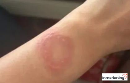 luka bakar pengguna Apple Watch