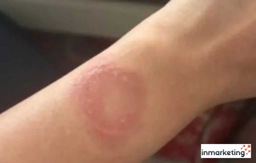 luka bakar pengguna Apple Watch